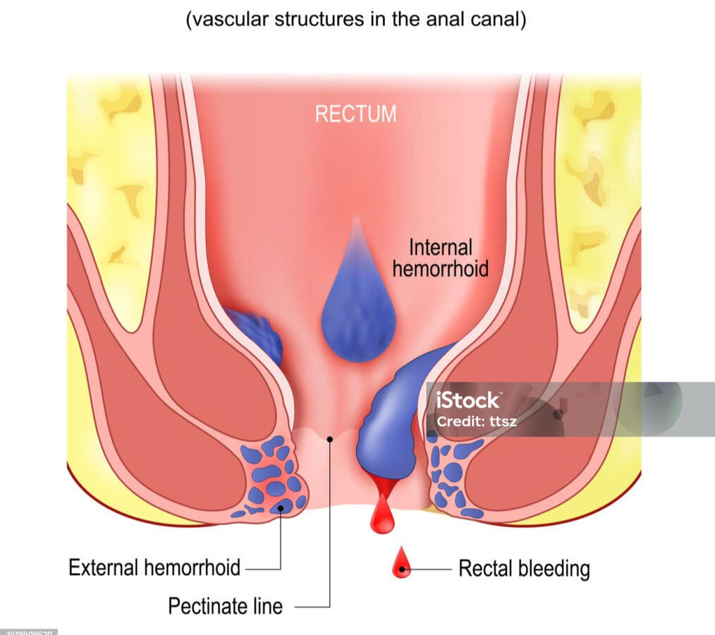 Hemorrhoids are swollen, inflamed veins in the anus or lower rectum, caused by increased pressure from activities like straining during bowel movements, chronic constipation, or pregnancy