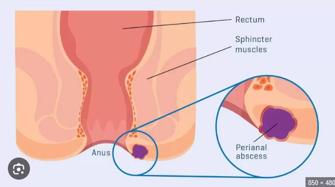 An anal abscess is a painful collection of pus that forms in the tissue near the anus, most often caused by an infection in one of the anal glands