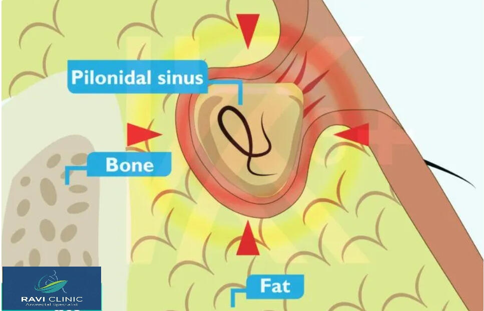 A pilonidal sinus is a small tunnel or cyst that forms in the skin, typically near the tailbone at the top of the buttocks