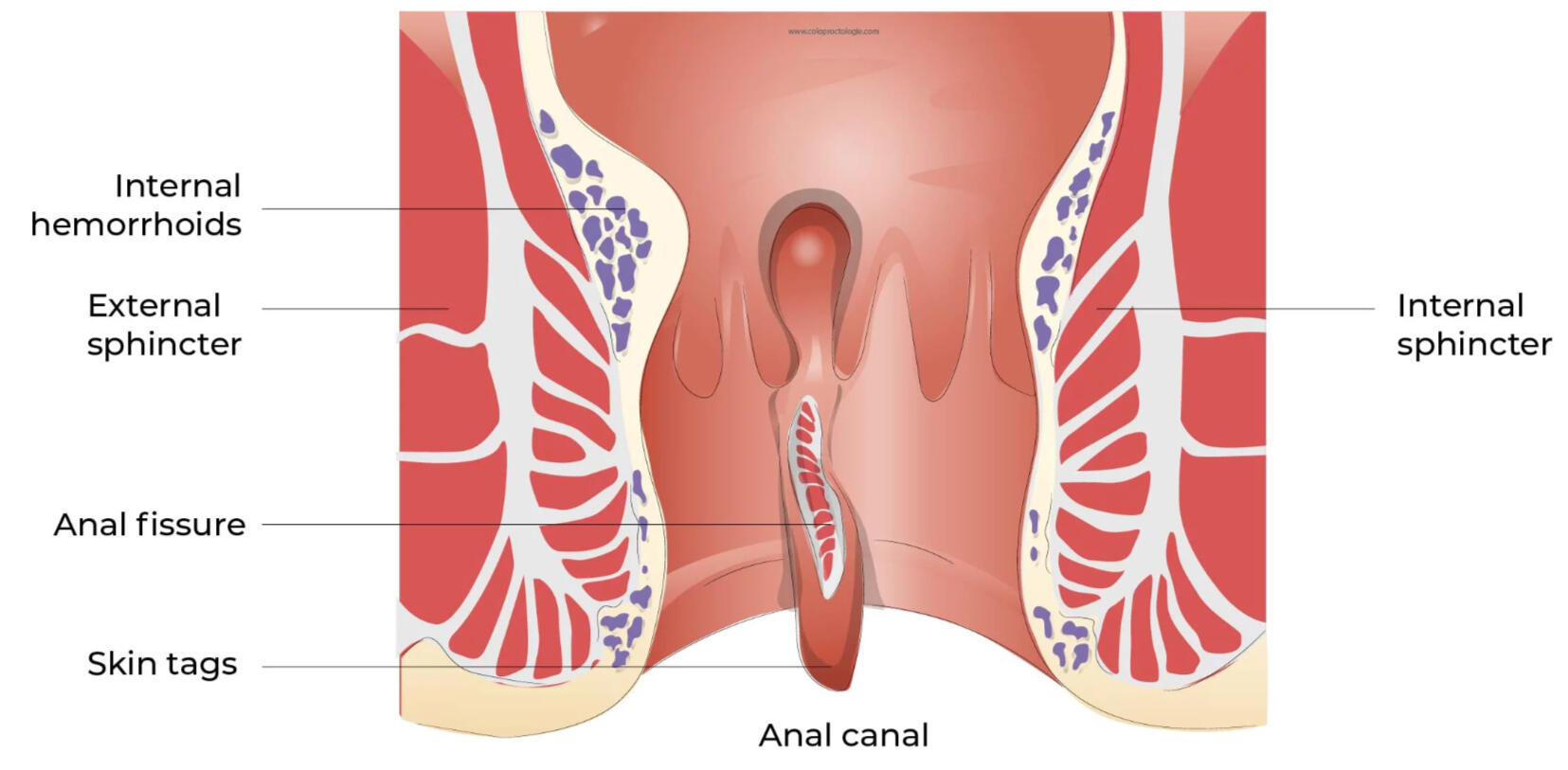 An anal fissure is a small tear in the lining of the anal canal, causing sharp pain and bleeding during or after bowel movements