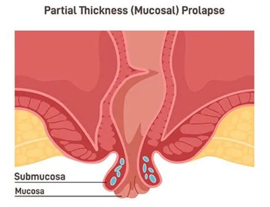 Rectal prolapse is when the rectum slips out of the anus, appearing as a reddish mass that can be seen outside the body.